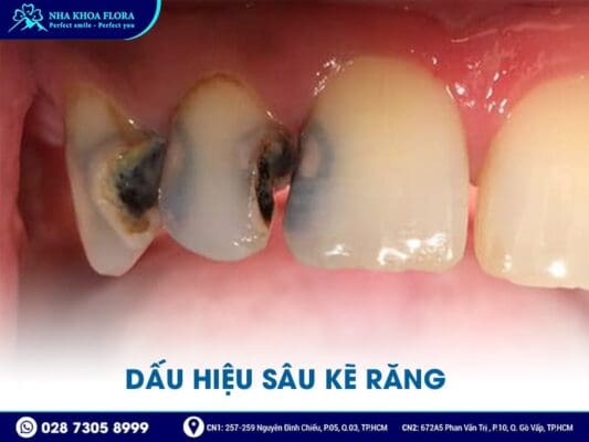 sâu kẽ răng - ảnh 2 sâu kẽ răng - ảnh 2