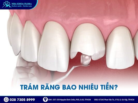 Trám răng bao nhiêu tiền? - Ảnh 1 Trám răng bao nhiêu tiền? - Ảnh 1