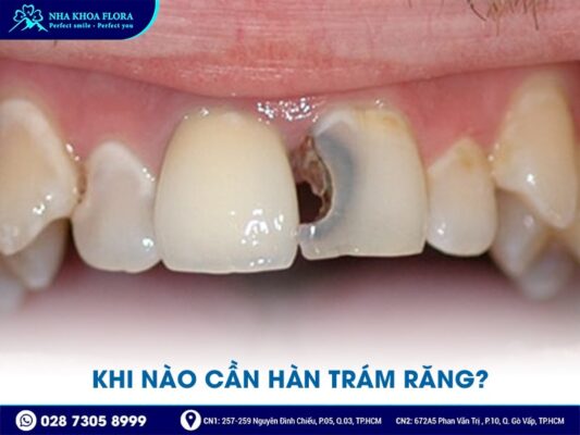 Trám răng bao nhiêu tiền? - Ảnh 3 Trám răng bao nhiêu tiền? - Ảnh 3