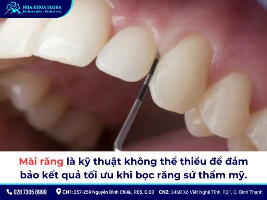 mài răng bọc sứ - ảnh 1 mài răng bọc sứ - ảnh 1