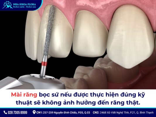 mài răng bọc sứ - ảnh 2 mài răng bọc sứ - ảnh 2