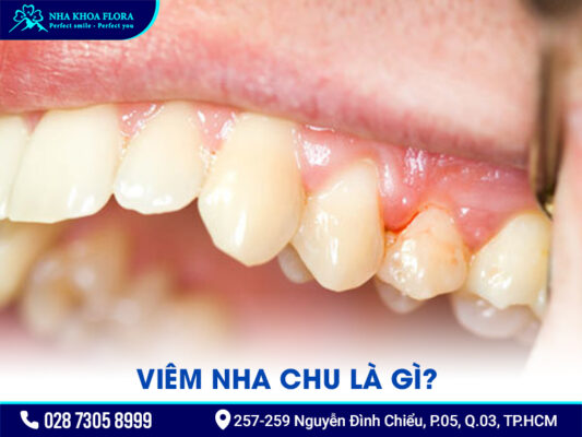 Bị nha chu có bọc răng sứ được không? - ảnh 1 Bị nha chu có bọc răng sứ được không? - ảnh 1