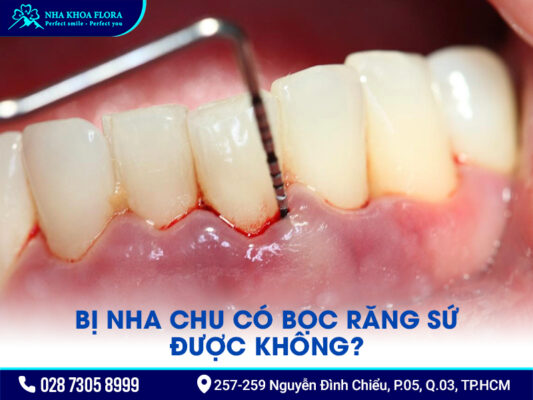Bị nha chu có bọc răng sứ được không? - ảnh 2 Bị nha chu có bọc răng sứ được không? - ảnh 2