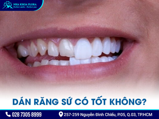 Dán răng sứ có tốt không? - ảnh 2 Dán răng sứ có tốt không? - ảnh 2
