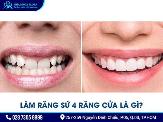 Làm răng sứ 4 răng cửa - ảnh 1 Làm răng sứ 4 răng cửa - ảnh 1