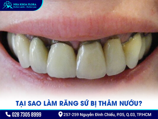 làm răng sứ bị thâm nướu - ảnh 1 làm răng sứ bị thâm nướu - ảnh 1