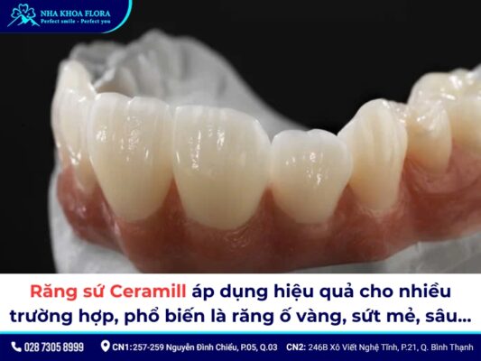 Răng sứ Ceramill - ảnh 5 Răng sứ Ceramill - ảnh 5