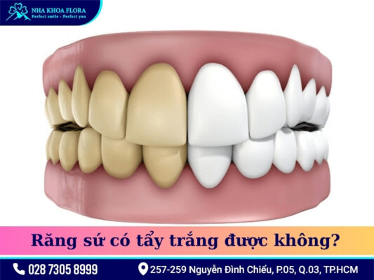 Răng sứ có tẩy trắng được không - ảnh 1 Răng sứ có tẩy trắng được không - ảnh 1