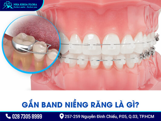 Band niềng răng - ảnh 1 Band niềng răng - ảnh 1