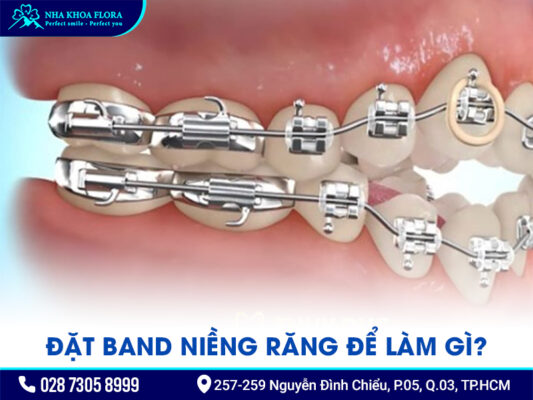 Band niềng răng - ảnh 2 Band niềng răng - ảnh 2
