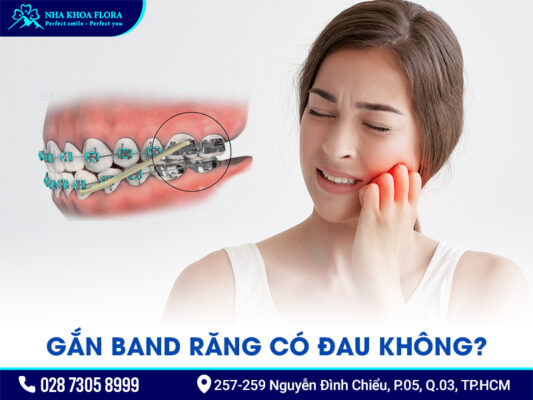 Band niềng răng - ảnh 4 Band niềng răng - ảnh 4