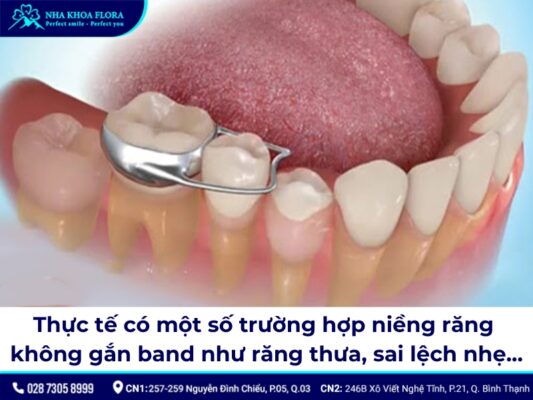 Band niềng răng - ảnh 5 Band niềng răng - ảnh 5