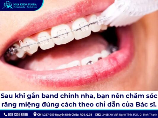 Band niềng răng - ảnh 6 Band niềng răng - ảnh 6