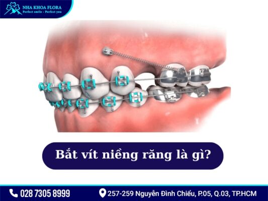 Bắt vít niềng răng - ảnh 1 Bắt vít niềng răng - ảnh 1