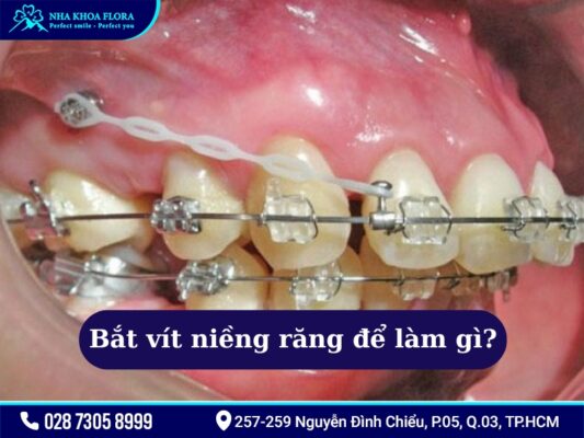 Bắt vít niềng răng - ảnh 2 Bắt vít niềng răng - ảnh 2