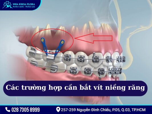 Bắt vít niềng răng - ảnh 3 Bắt vít niềng răng - ảnh 3