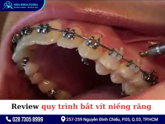 Bắt vít niềng răng - ảnh 4 Bắt vít niềng răng - ảnh 4