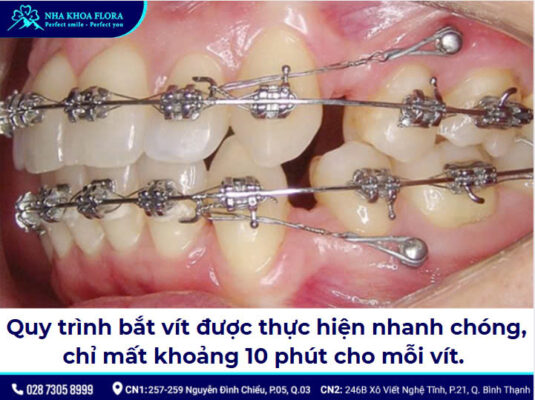 Bắt vít niềng răng - ảnh 5 Bắt vít niềng răng - ảnh 5