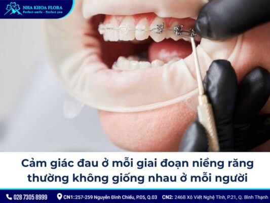 các giai đoạn niềng răng - ảnh 4 các giai đoạn niềng răng - ảnh 4