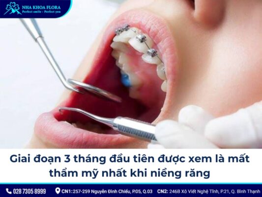 các giai đoạn niềng răng - ảnh 5 các giai đoạn niềng răng - ảnh 5