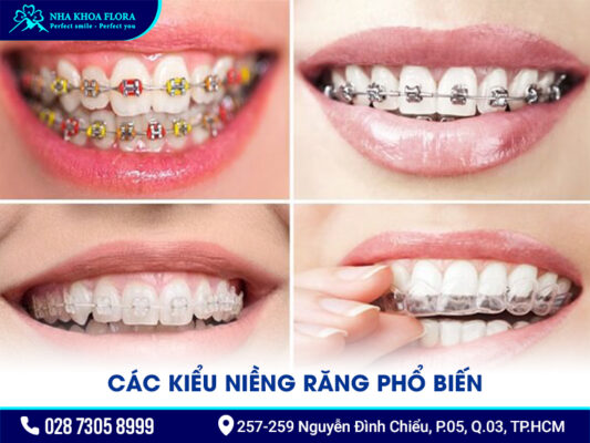 Các kiểu niềng răng - ảnh 1 Các kiểu niềng răng - ảnh 1