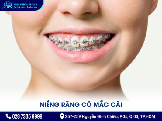 Các kiểu niềng răng - ảnh 2 Các kiểu niềng răng - ảnh 2