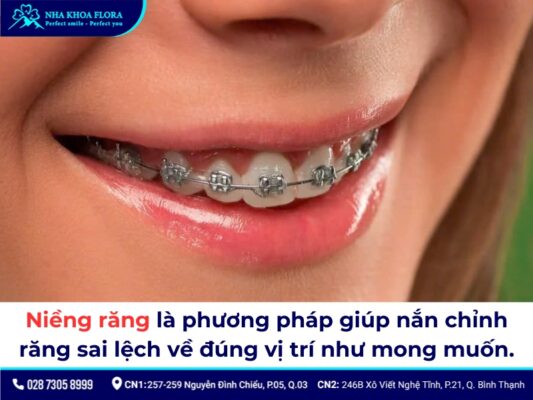 Có nên niềng răng không - ảnh 1 Có nên niềng răng không - ảnh 1
