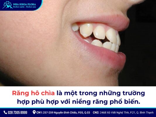Có nên niềng răng không - ảnh 5 Có nên niềng răng không - ảnh 5