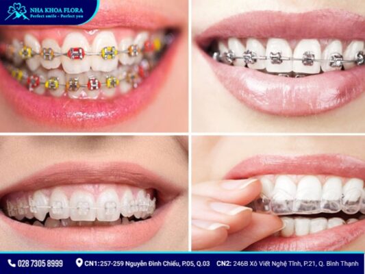 Có nên niềng răng không - ảnh 6 Có nên niềng răng không - ảnh 6