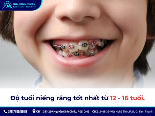 độ tuổi niềng răng - ảnh 2 độ tuổi niềng răng - ảnh 2