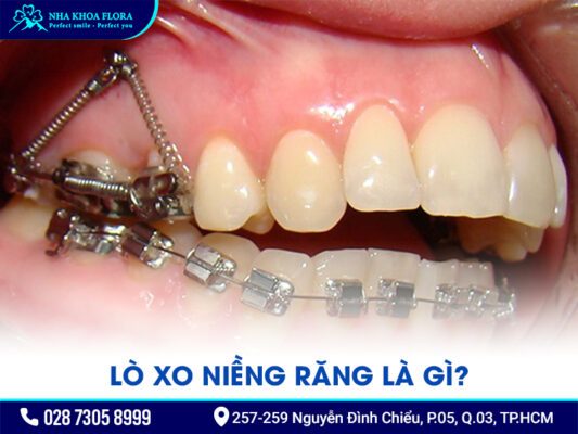Lò xo niềng răng - ảnh 1 Lò xo niềng răng - ảnh 1