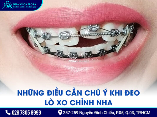Lò xo niềng răng - ảnh 4 Lò xo niềng răng - ảnh 4