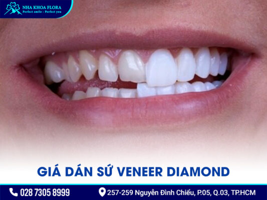 Mặt dán sứ Diamond - ảnh 5 Mặt dán sứ Diamond - ảnh 5