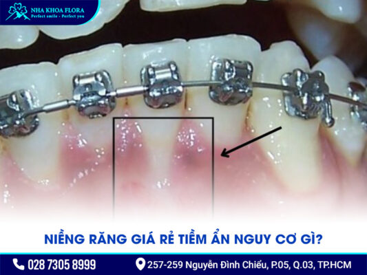 Niềng răng 5 triệu - ảnh 2 Niềng răng 5 triệu - ảnh 2