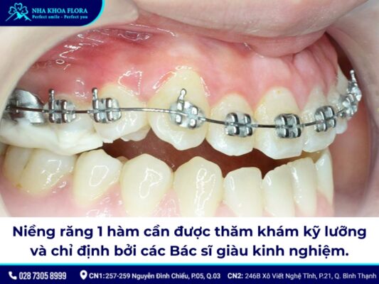 Niềng răng bao nhiêu tiền 1 hàm - ảnh 1 Niềng răng bao nhiêu tiền 1 hàm - ảnh 1