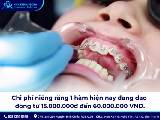 Niềng răng bao nhiêu tiền 1 hàm - ảnh 2 Niềng răng bao nhiêu tiền 1 hàm - ảnh 2