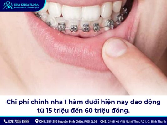 Niềng răng bao nhiêu tiền 1 hàm - ảnh 4 Niềng răng bao nhiêu tiền 1 hàm - ảnh 4