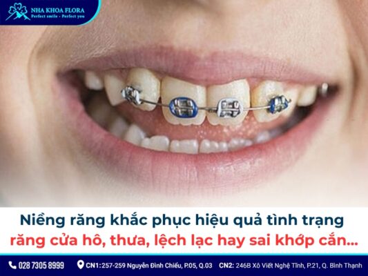 niềng răng cửa - ảnh 1 niềng răng cửa - ảnh 1