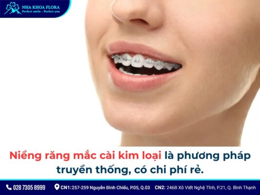 niềng răng cửa - ảnh 2 niềng răng cửa - ảnh 2