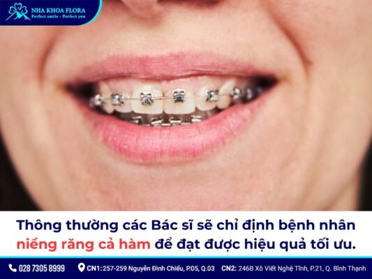 niềng răng cửa - ảnh 6 niềng răng cửa - ảnh 6
