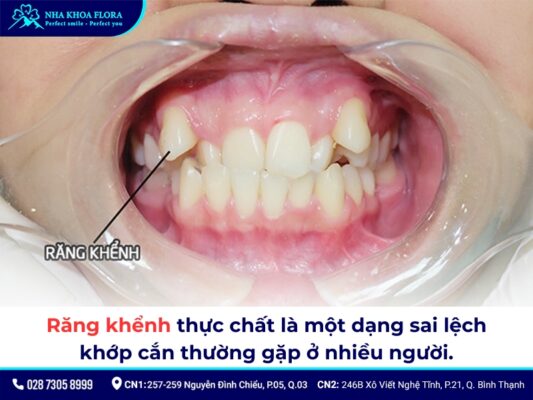 Niềng răng khểnh - ảnh 1 Niềng răng khểnh - ảnh 1
