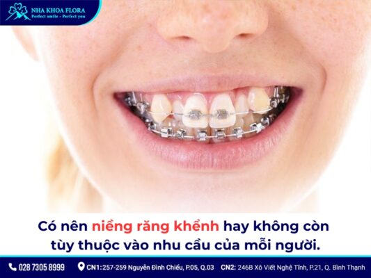 Niềng răng khểnh - ảnh 2 Niềng răng khểnh - ảnh 2