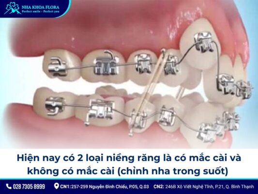 Niềng răng khểnh - ảnh 3 Niềng răng khểnh - ảnh 3