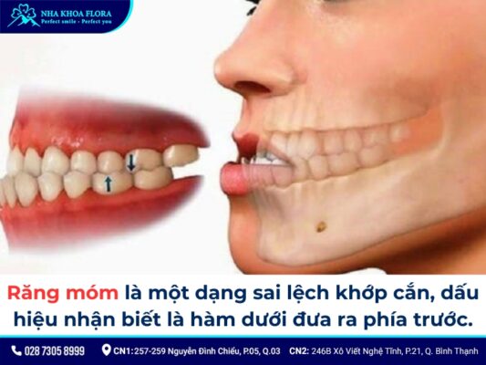 niềng răng móm - ảnh 1 niềng răng móm - ảnh 1