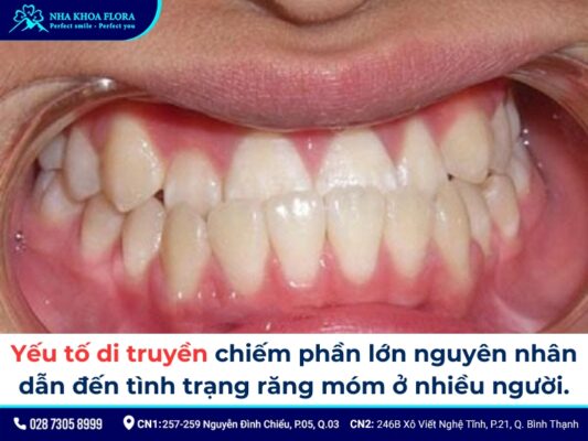 niềng răng móm - ảnh 2 niềng răng móm - ảnh 2