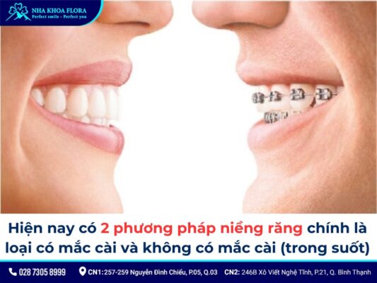niềng răng móm - ảnh 4 niềng răng móm - ảnh 4