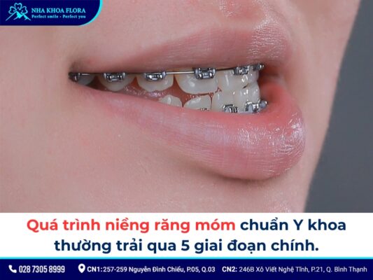 niềng răng móm - ảnh 5 niềng răng móm - ảnh 5