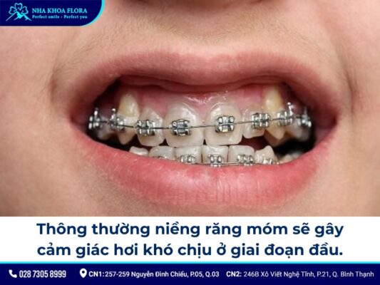 niềng răng móm - ảnh 6 niềng răng móm - ảnh 6