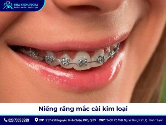 niềng răng người lớn - ảnh 5 niềng răng người lớn - ảnh 5