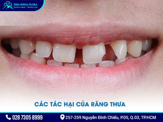 Niềng răng thưa 1 hàm giá bao nhiêu - ảnh 2 Niềng răng thưa 1 hàm giá bao nhiêu - ảnh 2
